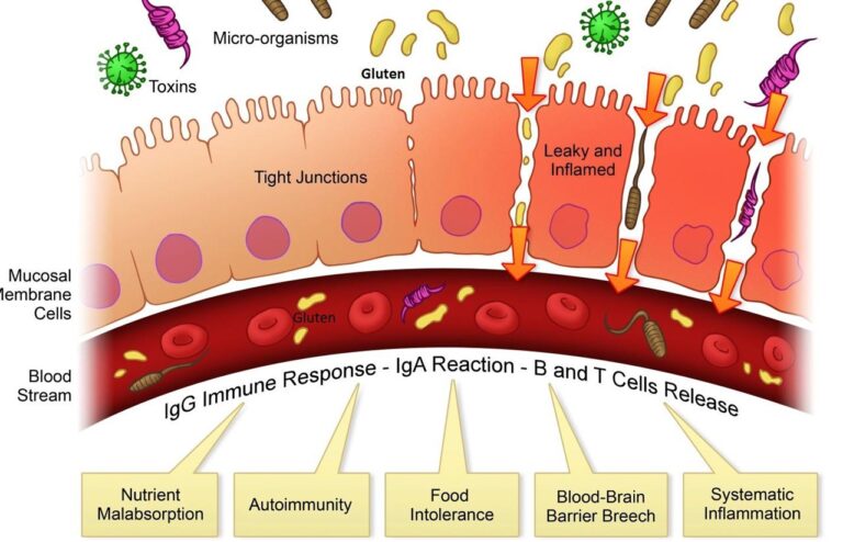 Disease Begins in the (Leaky) Gut